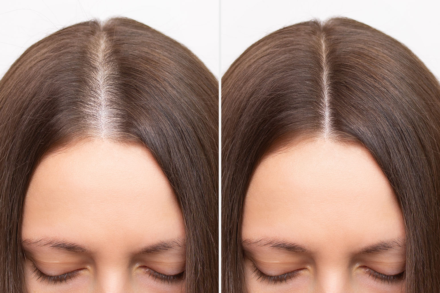 prf hair resotration
