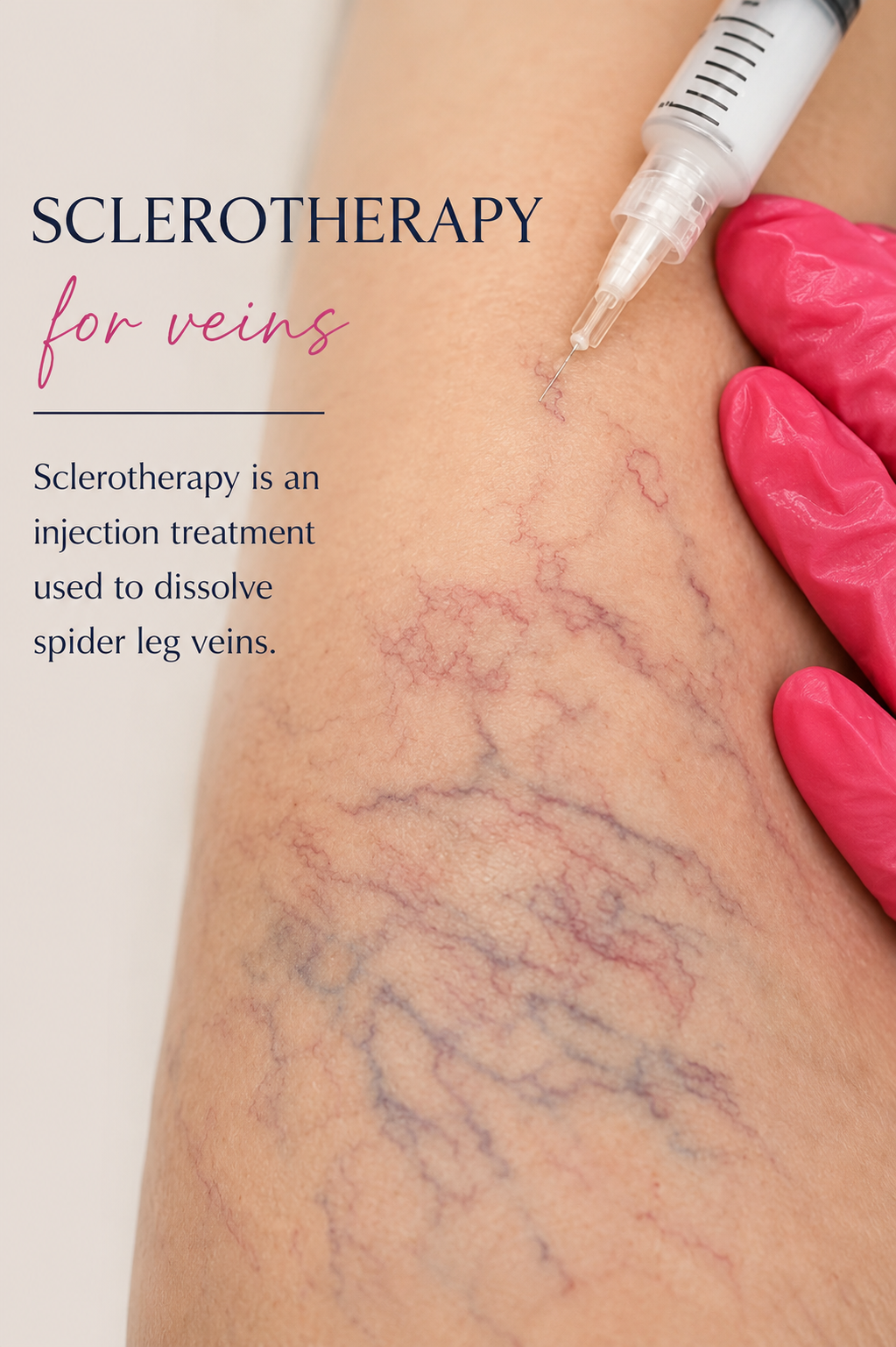 Sclerotherapy treatment for spider veins at 88 Wellness & Aesthetics in Burleson TX