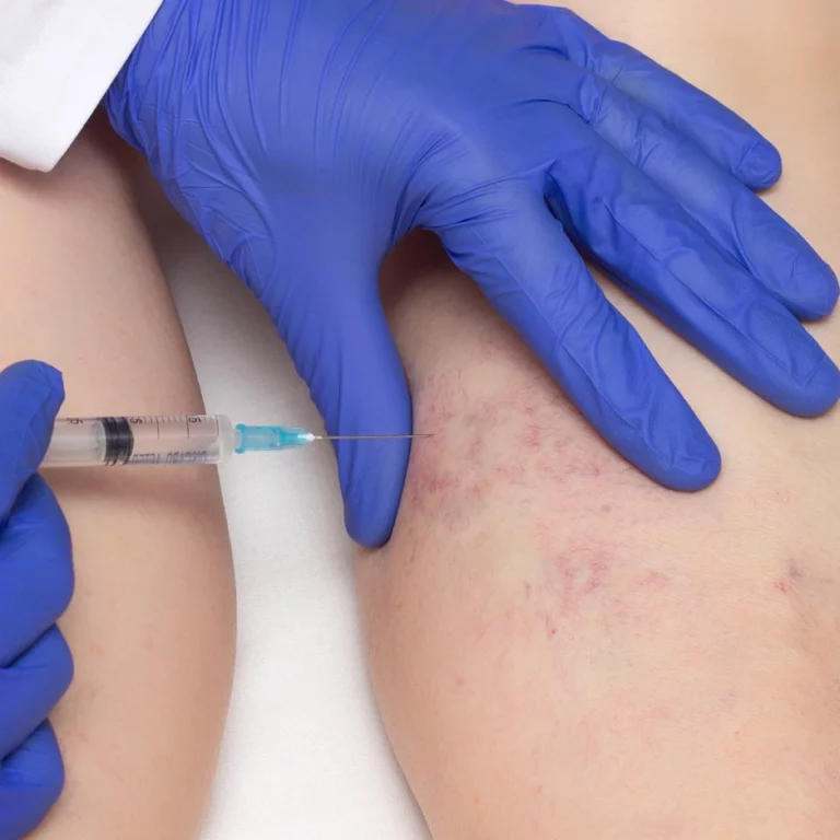 Sclerotherapy treatment for spider veins at 88 Wellness & Aesthetics in Burleson TX